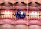 Hismile v34 Colour Corrector Serum Purple Teeth Whitening & Stain Removal